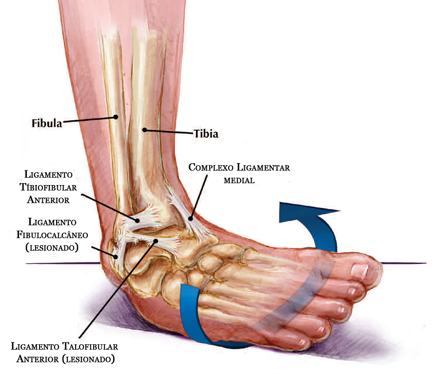 Entorse de Tornozelo